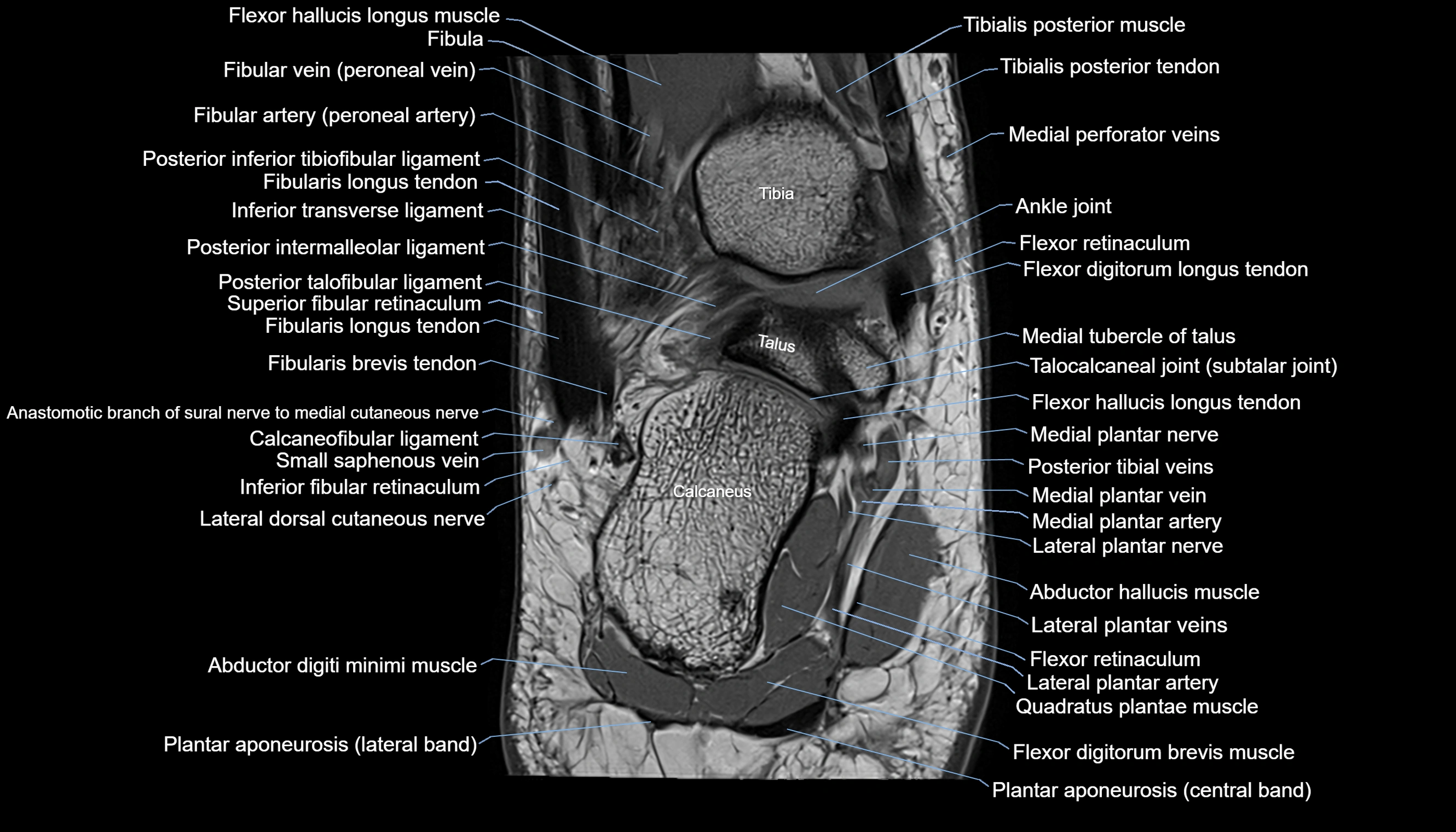 Ankle coronal anatomy 3T MRI images -img-11001-00018.webp